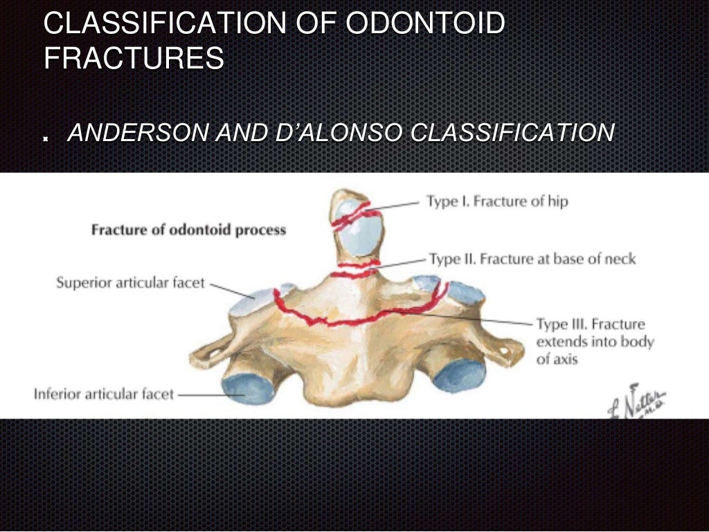 Non union of odontoid fractures