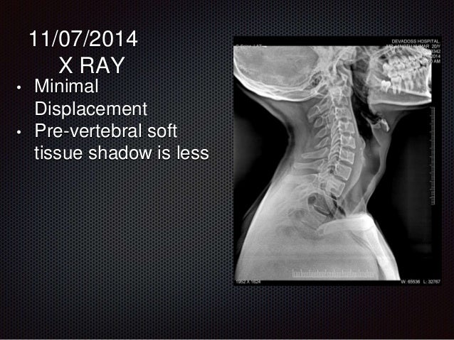 odontoid fracture non healing icd 10 odontoid fracture non healing icd 10