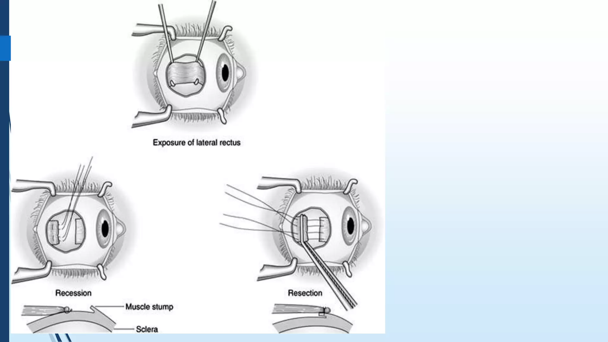 Non- Accommodative Convergent Squint