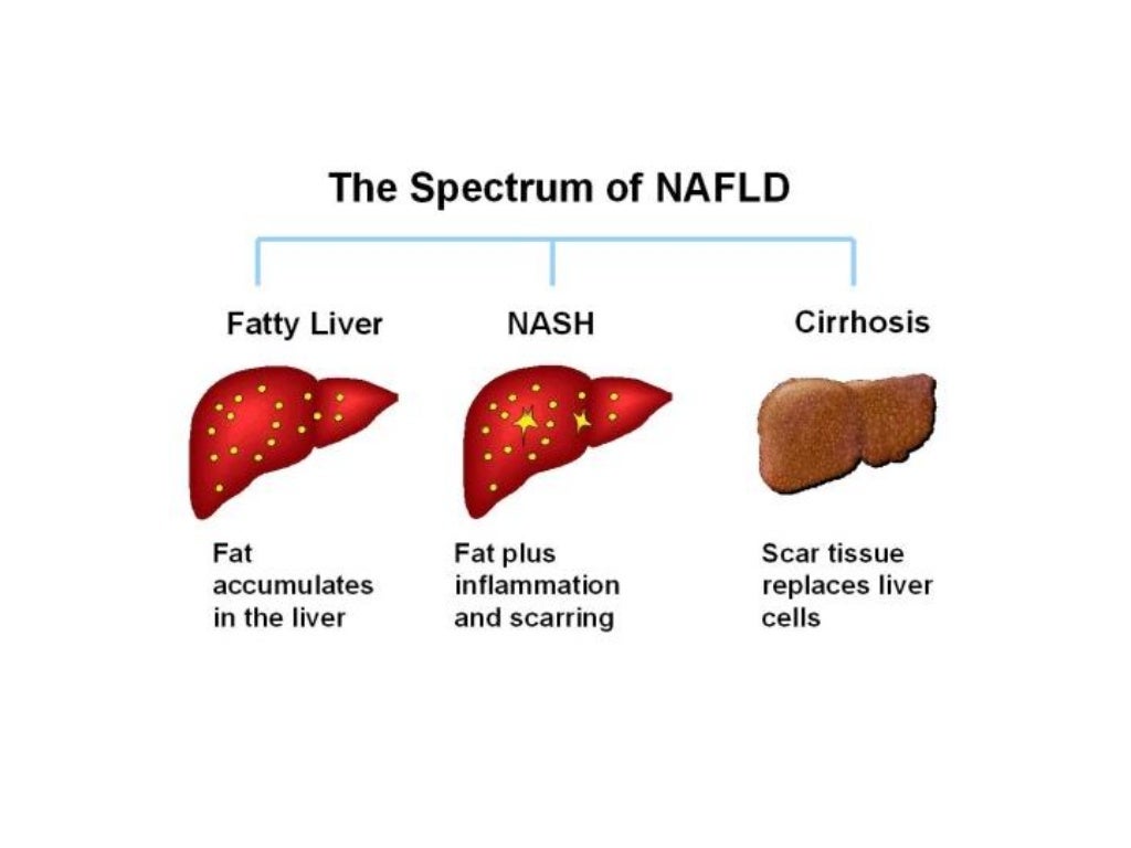 Nonalcoholic fatty liver disease in children and adolescents