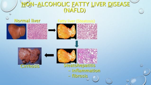 Non alcoholic fatty liver disease presentation | PPTX