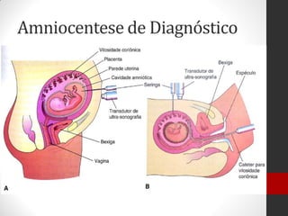 Amniocentese de Diagnóstico
 