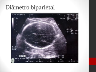 Diâmetro biparietal
 
