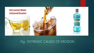 Fig : EXTRINSIC CAUSES OF EROSION
 