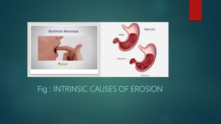 Fig : INTRINSIC CAUSES OF EROSION
 