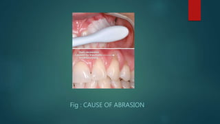 Fig : CAUSE OF ABRASION
 