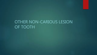 OTHER NON-CARIOUS LESION
OF TOOTH
 