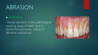 ABRASION
 Definition
Dental abrasion is the pathological
wearing away of teeth due to
abnormal processes, habits or
abrasive substances.
 