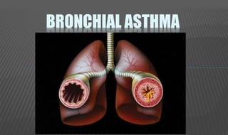 BRONCHIAL ASTHMA
 