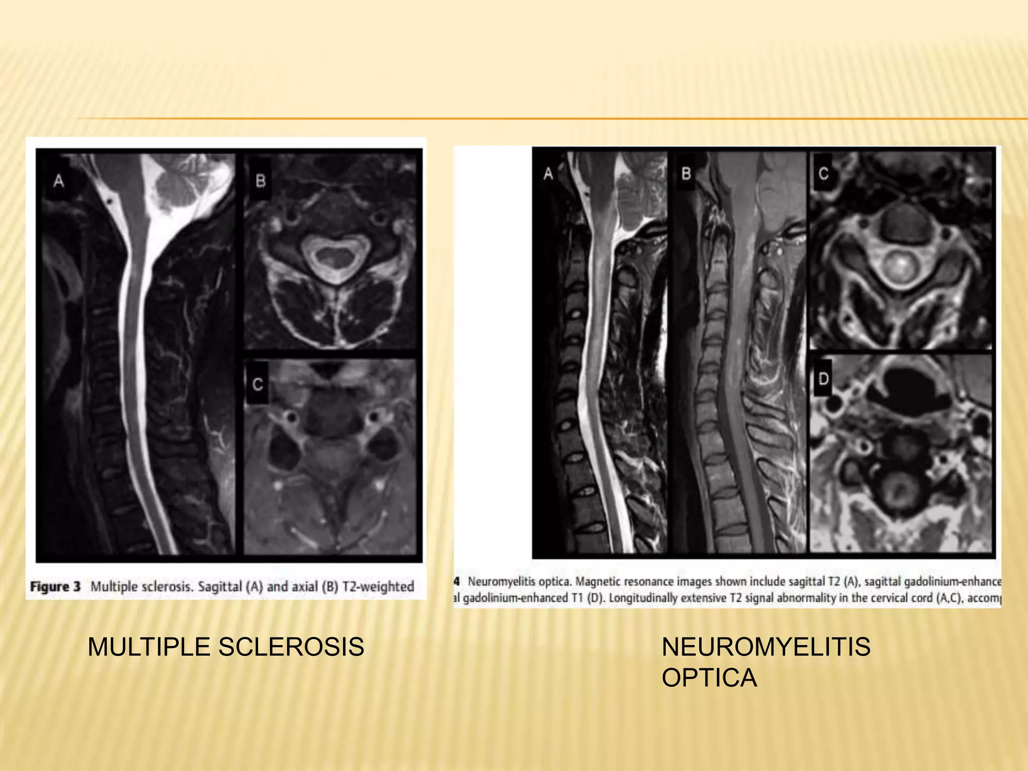MULTIPLE SCLEROSIS

NEUROMYELITIS
OPTICA

 