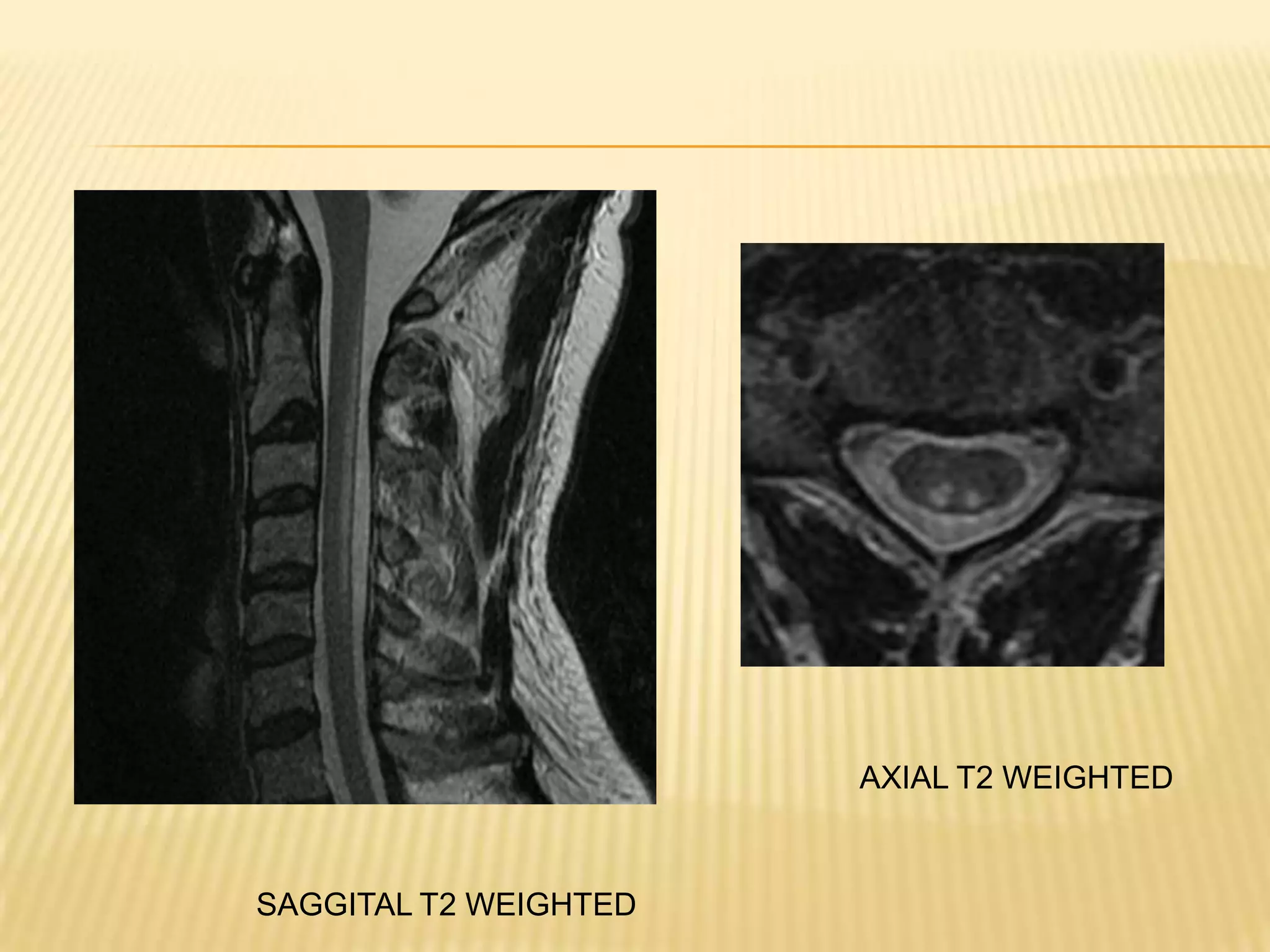 AXIAL T2 WEIGHTED

SAGGITAL T2 WEIGHTED

 