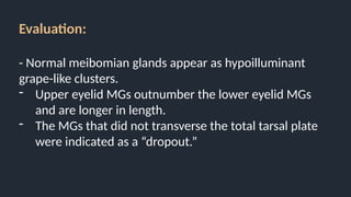 Evaluation:
- Normal meibomian glands appear as hypoilluminant
grape-like clusters.
- Upper eyelid MGs outnumber the lower eyelid MGs
and are longer in length.
- The MGs that did not transverse the total tarsal plate
were indicated as a “dropout.”
 