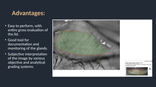 Advantages:
• Easy to perform, with
entire gross evaluation of
the lid.
• Good tool for
documentation and
monitoring of the glands.
• Subjective interpretation
of the image by various
objective and analytical
grading systems.
 