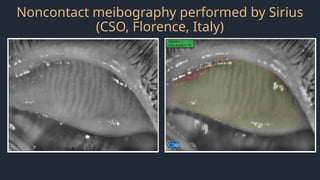 Noncontact meibography performed by Sirius
(CSO, Florence, Italy)
 