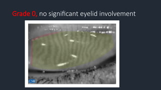 Grade 0, no significant eyelid involvement
 