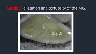 Grade 1: dilatation and tortuosity of the MG.
 
