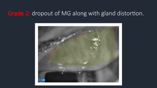 Grade 2: dropout of MG along with gland distortion.
 