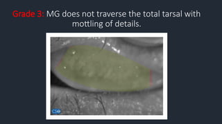 Grade 3: MG does not traverse the total tarsal with
mottling of details.
 