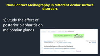 Non-Contact Meibography in different ocular surface
disorders
1) Study the effect of
posterior blepharitis on
meibomian glands
 