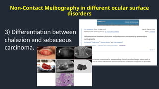 Non-Contact Meibography in different ocular surface
disorders
3) Differentiation between
chalazion and sebaceous
carcinoma.
 