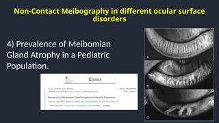 Non-Contact Meibography in different ocular surface
disorders
4) Prevalence of Meibomian
Gland Atrophy in a Pediatric
Population.
 