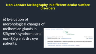 Non-Contact Meibography in different ocular surface
disorders
6) Evaluation of
morphological changes of
meibomian glands in
Sjögren’s syndrome and
non-Sjögren’s dry eye
patients.
 