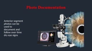 Photo Documentation
Anterior segment
photos can be
used to
document and
follow over time
dry eye signs
 