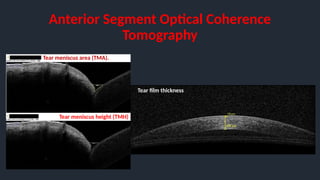 Anterior Segment Optical Coherence
Tomography
Tear film thickness
Tear meniscus area (TMA).
Tear meniscus height (TMH)
 
