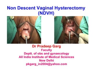 Non Descent Vaginal Hysterectomy (NDVH) Dr Pradeep Garg Faculty Deptt. of obs and gynaecology All India Institute of Medical Sciences New Delhi [email_address] 