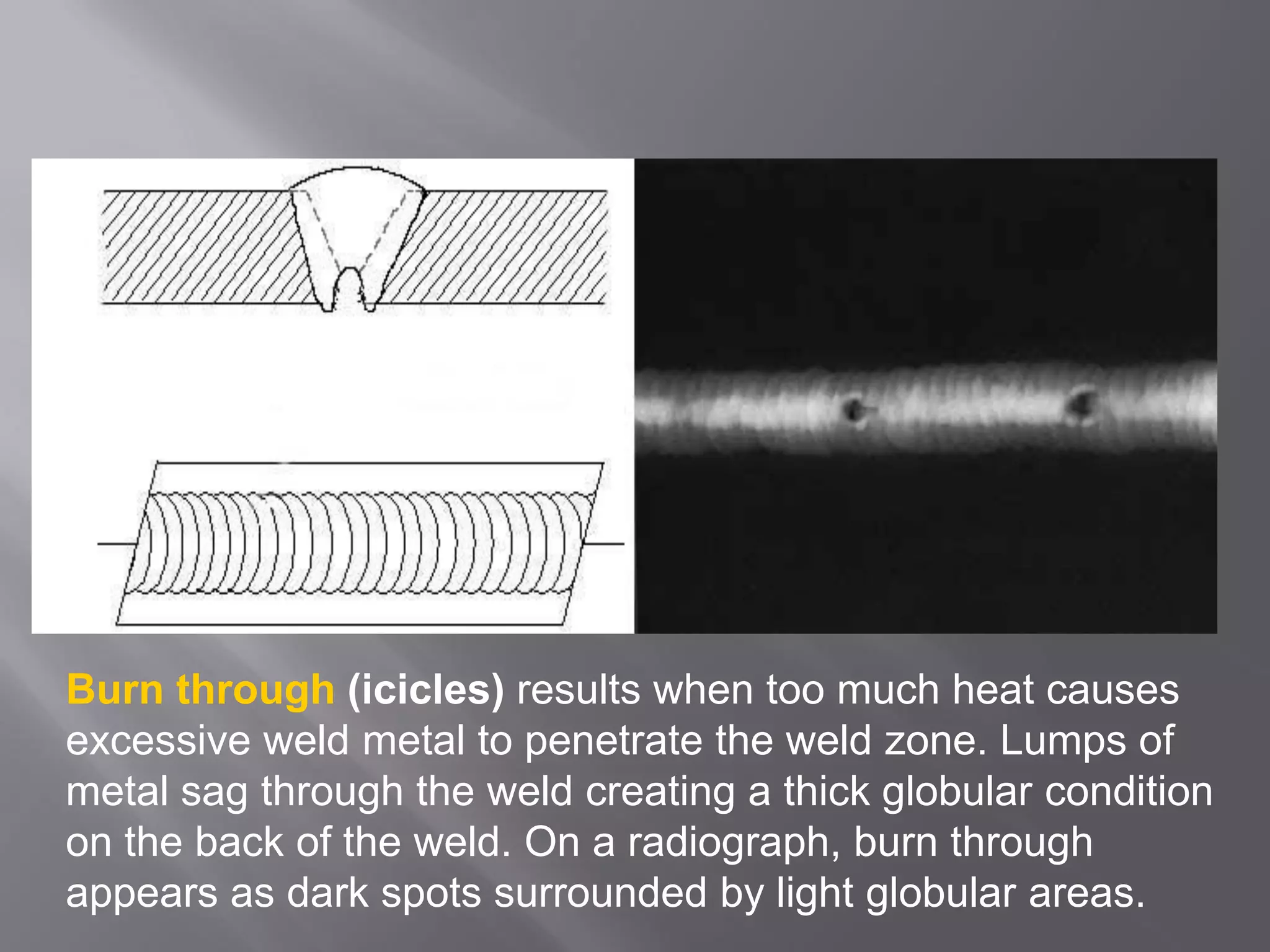 Burn through (icicles) results when too much heat causes
excessive weld metal to penetrate the weld zone. Lumps of
metal sag through the weld creating a thick globular condition
on the back of the weld. On a radiograph, burn through
appears as dark spots surrounded by light globular areas.
 