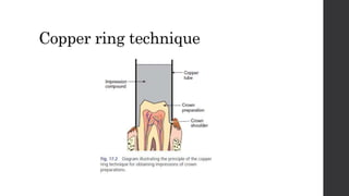 Copper ring technique
 