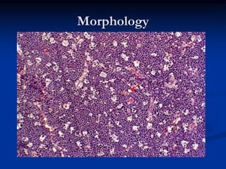 Non hodgkin lymphoma | PPTX