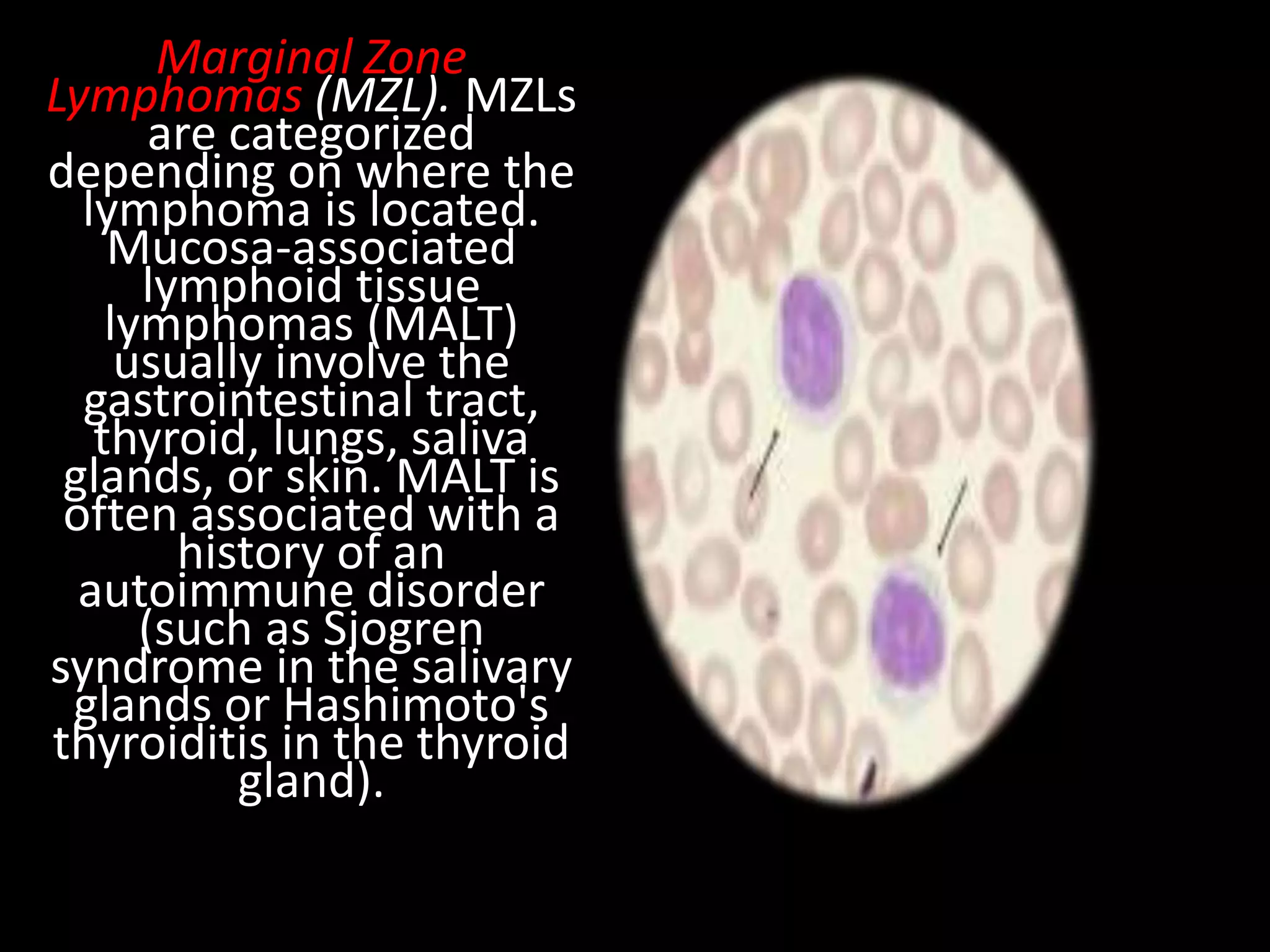 non-hodgkins-lymphoma-nandhu-pptx