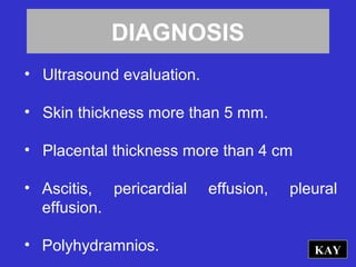 DIAGNOSIS
• Ultrasound evaluation.
• Skin thickness more than 5 mm.
• Placental thickness more than 4 cm
• Ascitis, pericardial effusion, pleural
effusion.
• Polyhydramnios. KAY
 