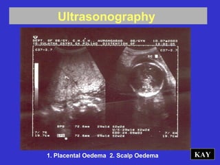 Ultrasonography
KAY1. Placental Oedema 2. Scalp Oedema
 