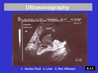 Ultrasonography
KAY1. Ascitic Fluid 2. Liver 3. Peri. Effusion
 