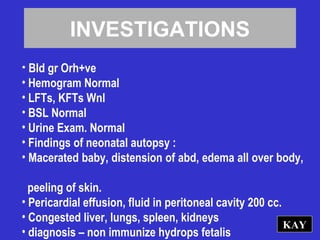 INVESTIGATIONS
• Bld gr Orh+ve
• Hemogram Normal
• LFTs, KFTs Wnl
• BSL Normal
• Urine Exam. Normal
• Findings of neonatal autopsy :
• Macerated baby, distension of abd, edema all over body,
peeling of skin.
• Pericardial effusion, fluid in peritoneal cavity 200 cc.
• Congested liver, lungs, spleen, kidneys
• diagnosis – non immunize hydrops fetalis
KAY
 