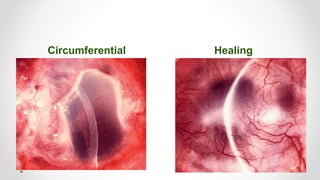 Circumferential Healing
 