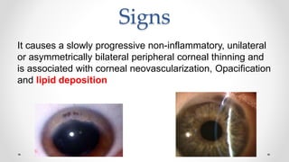 Signs
It causes a slowly progressive non-inflammatory, unilateral
or asymmetrically bilateral peripheral corneal thinning and
is associated with corneal neovascularization, Opacification
and lipid deposition
 