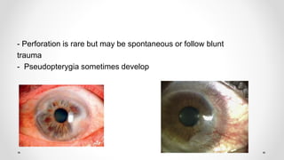 - Perforation is rare but may be spontaneous or follow blunt
trauma
- Pseudopterygia sometimes develop
 