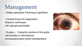 Management
• Safety spectacles if thinning is significant
• Contact lenses for astigmatism.
Scleral or soft lenses
with rigid gas permeable
• Surgery :- Cresentric excision of the gutter
with lamellar or full-thickness
corneoscleral patch grafts transplantation
 