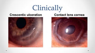 Clinically
Crescentic ulceration Contact lens cornea
 