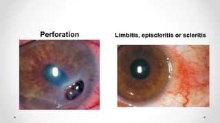 Perforation Limbitis, episcleritis or scleritis
 
