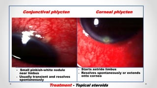 • Small pinkish-white nodule
near limbus
• Usually transient and resolves
spontaneously
• Starts astride limbus
• Resolves spontaneously or extends
onto cornea
Conjunctival phlycten
Treatment - Topical steroids
Corneal phlycten
 