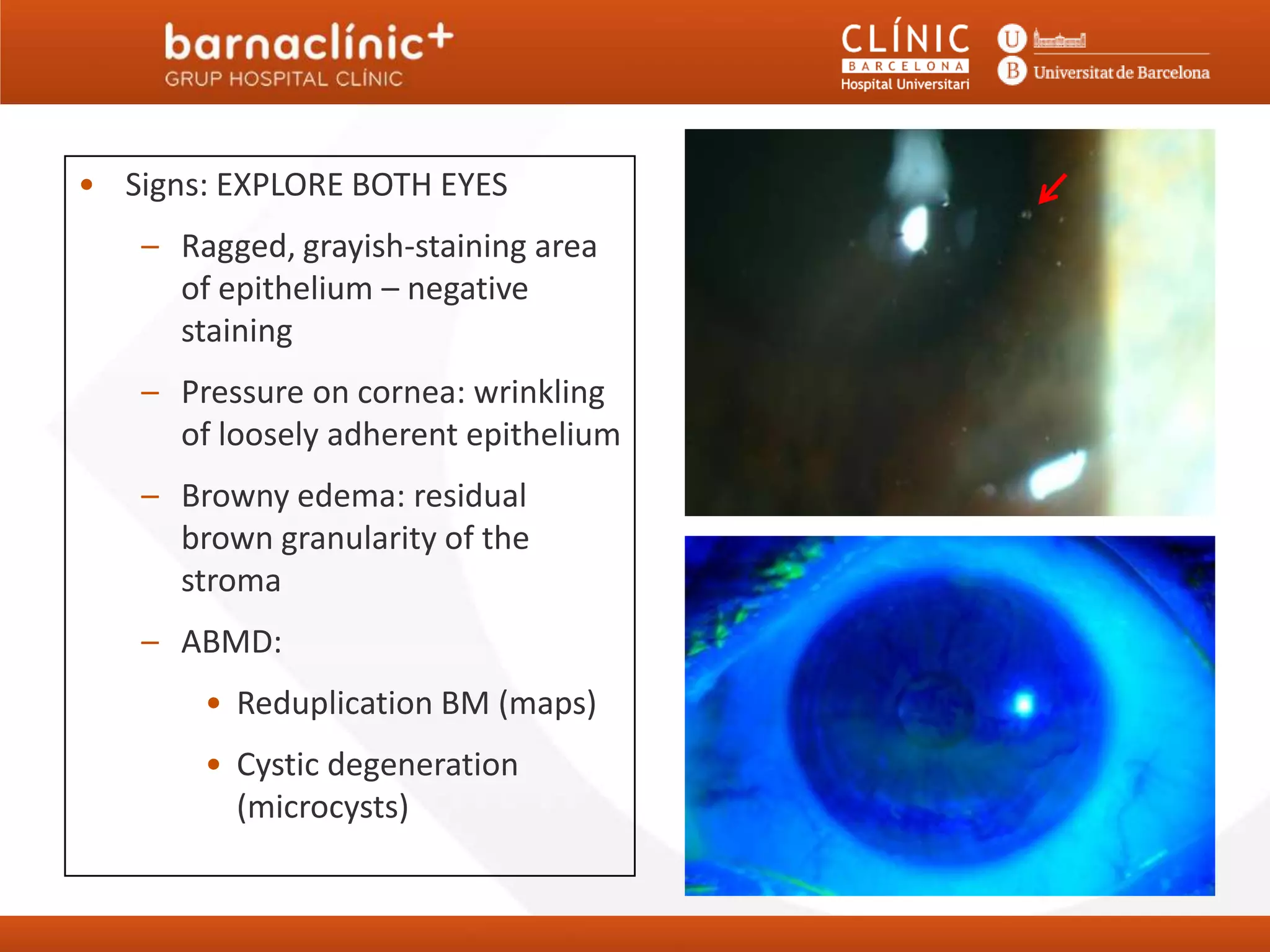 Noninfectious keratitis barnaclinic | PPTX