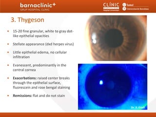 3. Thygeson
•   15-20 fine granular, white to gray dot-
    like epithelial opacities

•   Stellate appearance (dxd herpes virus)

•   Little epithelial edema, no cellular
    infiltration

•   Evanescent, predominantly in the
    central cornea

•   Exacerbations: raised center breaks
    through the epithelial surface,
    fluorescein and rose bengal staining

•   Remissions: flat and do not stain

                                              Dr. JL Güell
 