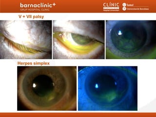 V + VII palsy




Herpes simplex
 