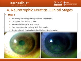 4. Neurotrophic Keratitis: Clinical Stages
• Stage 1
   –   Rose bengal staining of the palpebral conjunctiva
   –   Decreased tear break-up time
   –   Increased viscosity of tear mucus
   –   Punctate epithelial staining with fluorescein
   –   Scattered small facets of dried epithelium (Gaule spots)
 