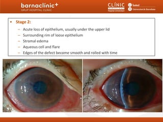 • Stage 2:
    4. Neurotrophic Keratitis: Clinical Stages
   –   Acute loss of epithelium, usually under the upper lid
   –   Surrounding rim of loose epithelium
   –   Stromal edema
   –   Aqueous cell and flare
   –   Edges of the defect become smooth and rolled with time
 