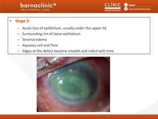 • Stage 2:
    4. Neurotrophic Keratitis: Clinical Stages
   – Acute loss of epithelium, usually under the upper lid
   –   Surrounding rim of loose epithelium
   –   Stromal edema
   –   Aqueous cell and flare
   –   Edges of the defect become smooth and rolled with time
 